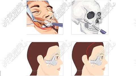 顴骨手術(shù)過程