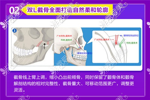 广州颧骨内推一般多少钱?推荐几家广州能做颧骨手术的医院!