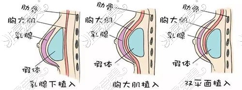 济南韩氏隆胸