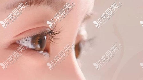 宁波双眼皮手术