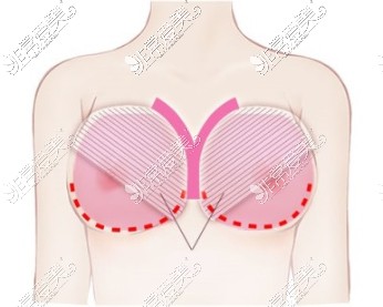 假体隆胸乳沟塑造