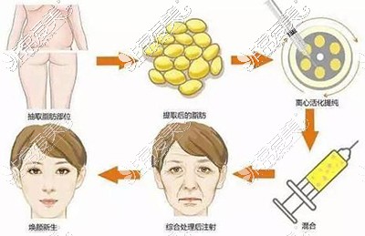 脂肪填充多久才算存活下来？脂肪填充15天全部吸收可能吗？