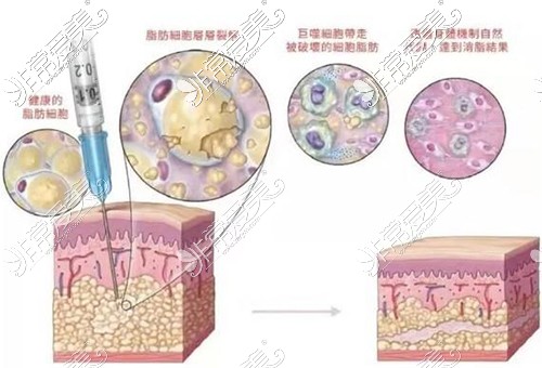 脂肪填充多久才算存活下来？脂肪填充15天全部吸收可能吗？