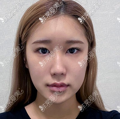 韩国优雅人隆鼻照片