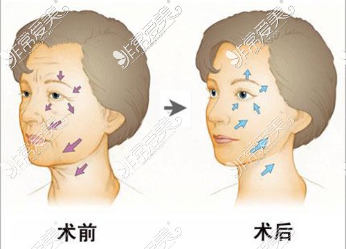 哈尔滨做面部拉皮一般需要多少钱?你想要的医生价格都在内