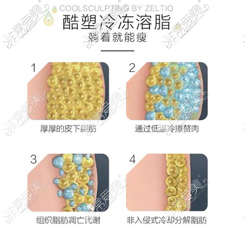 酷塑吸脂详解 酷塑吸脂详解