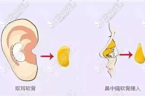 耳软骨隆鼻操作示意图