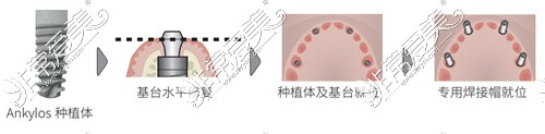 速齒冷焊種植步驟