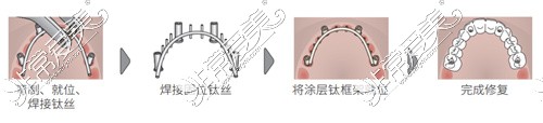 速齿冷焊种植步骤图解