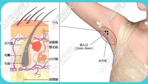 郑州哪个医院看狐臭比较好？治疗腋臭哪种方法更有效？