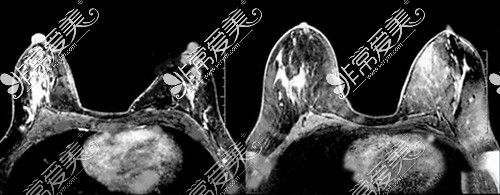 自体脂肪隆胸前后CT拍照对比