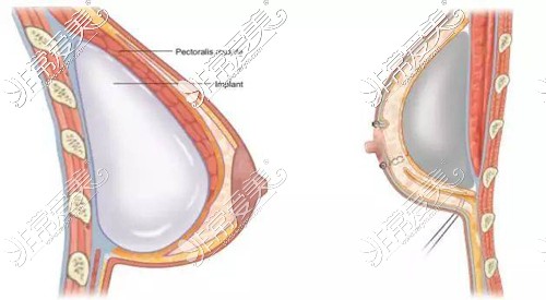 假体隆胸产生包膜挛缩