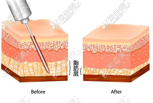 大腿吸脂一般多少个部位?需要多少钱?分析大腿吸脂费用!