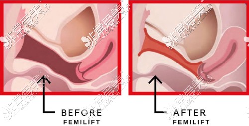 女性必读:激光紧缩术效果好吗?做一次有没有明显效果?