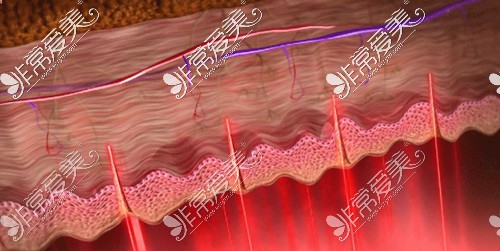 激光穿透皮肤原理图