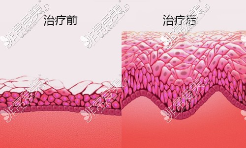 激光紧缩阴道前后内壁厚度