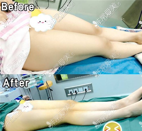 吸脂前后对比 吸脂前后对比