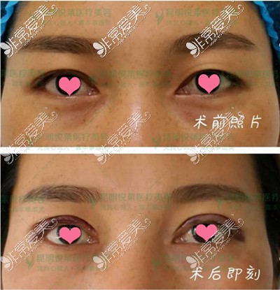昆明悦莱刘氏双眼皮手术前和术后即刻效果对比图