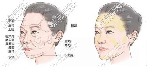 面部脂肪填充区域分析图