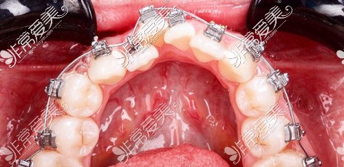金属托槽矫正器佩戴效果
