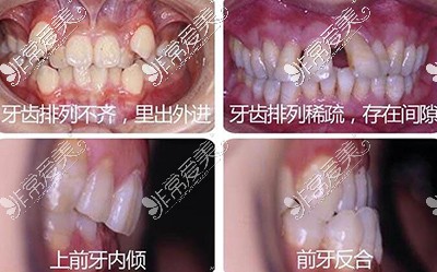 难度比较大的正畸类型