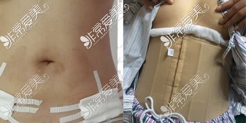 腰腹吸脂后多少天才不会疼？做腰腹吸脂多久可以恢复？