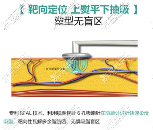 黃金微雕吸脂原理展示