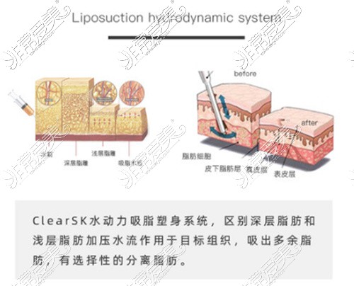 水动力吸脂优势介绍