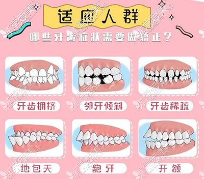 哪些牙齿需要进行正畸改善