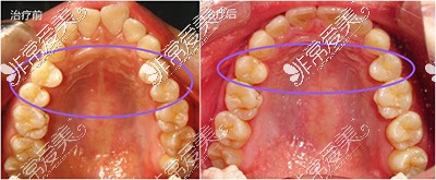 牙齿歪斜矫正前后对比效果