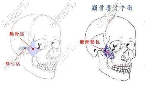 顴骨磨骨手術(shù)