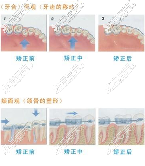 牙齿矫正过程图