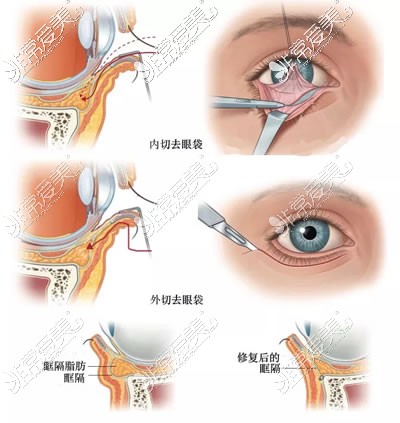 內(nèi)外切去眼袋圖片