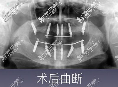 全口牙缺失术后CT图