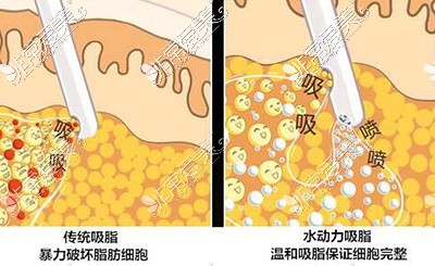 卡通吸脂前后对比照片 卡通吸脂前后对比照片