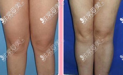 大腿吸脂前后对比照片 大腿吸脂前后对比照片