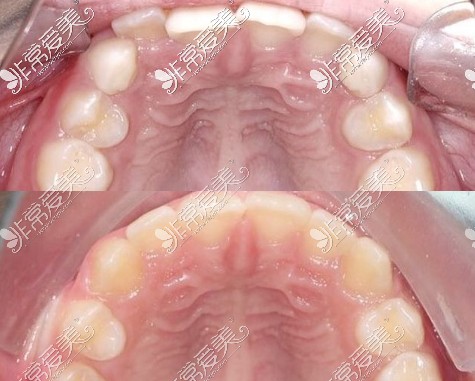 儿童牙齿矫正前牙改善