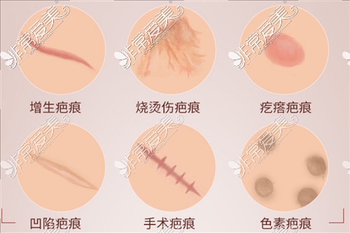 6种常见疤痕类型