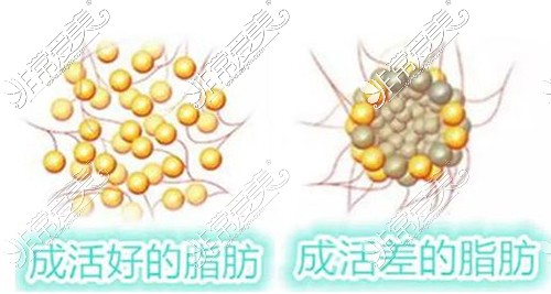 全脸脂肪填充有后遗症吗？分享脂肪填充全脸注意事项！