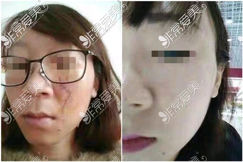 郑州广运医疗祛除面部明显疤痕手术对比