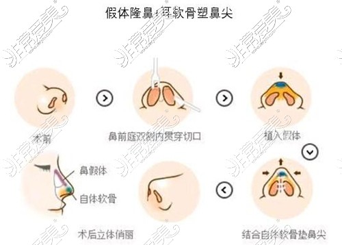 假体隆鼻+耳软骨塑鼻尖综合手术