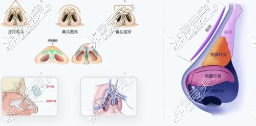 自体软骨鼻综合手术