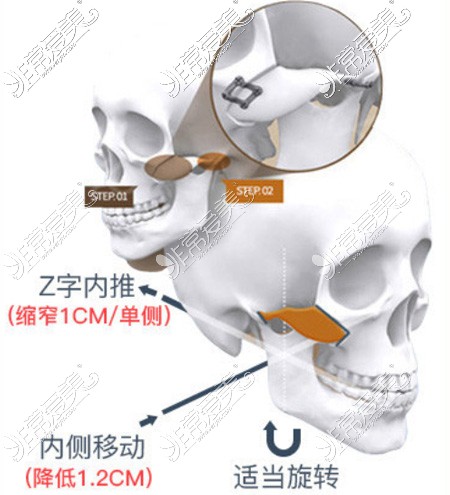 杭州时光医疗美容医院颧骨内推技术