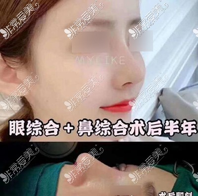 石家庄美莱整形医院隆鼻照片