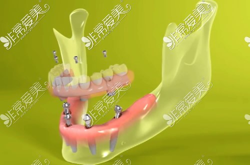 半口牙种植大约多少钱，All-ON-4一般需要几颗种植体？