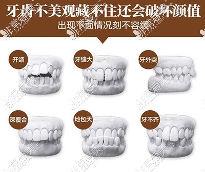 哪些牙齿需要做箍牙改善