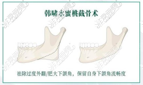 韩氏整形医院水蜜桃截骨术