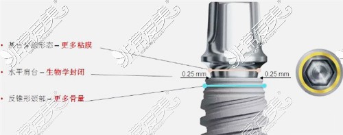 ﻿诺贝尔active种植体优点和植牙价格分析，跟cc的区别在哪？