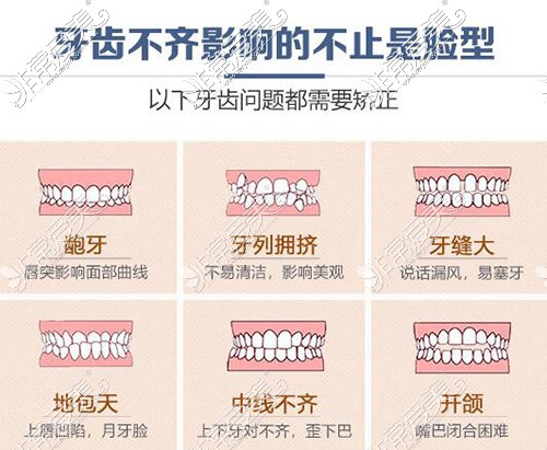 哪些牙齿需要做矫正改善