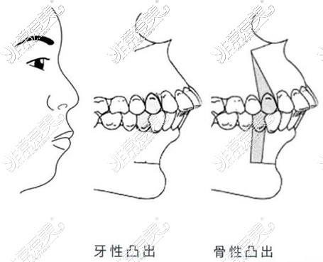 骨性突嘴和牙性突嘴对比